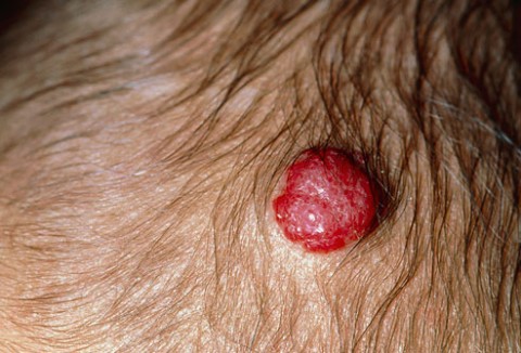 草莓状毛细血管瘤